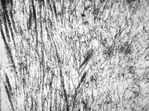 M,71y. | amyloid - glandula vesiculosa M,71y. | amyloid - glandula vesiculosa